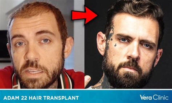 Adam22 Shows Off Hair Transplant Results