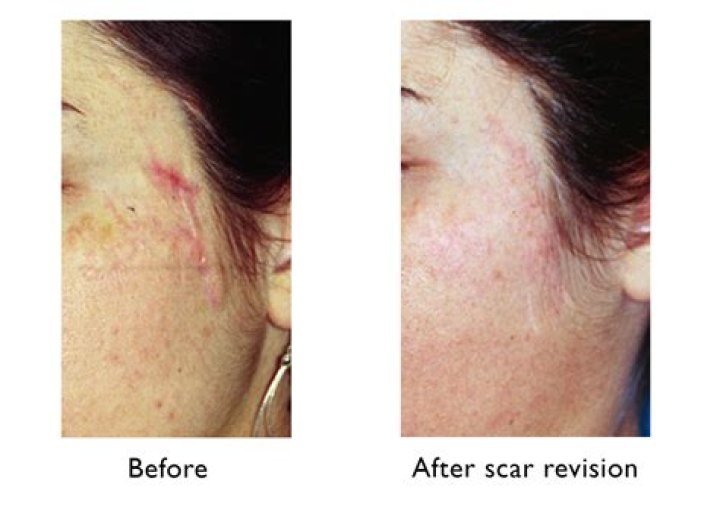 How to Reduce and Lighten Scars, According to Aesthetic Experts